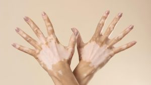 01/8 – Dia Nacional dos Portadores de Vitiligo