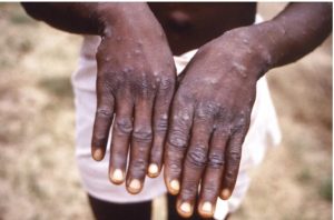 Mpox (varíola dos macacos)