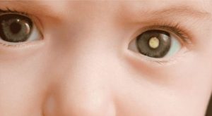18/9 – Dia Nacional de Conscientização e Incentivo ao Diagnóstico Precoce do Retinoblastoma