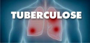 17/11 – Dia Nacional de Combate à Tuberculose