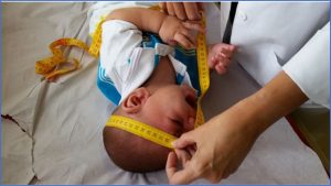 Zika provoca anormalidade em quase um terço dos filhos de mulheres infectadas na gravidez
