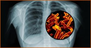 Instituto Adolfo Lutz e USP detectam primeiros casos de tuberculose extensivamente resistente no Brasil