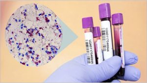 Técnica usa anticorpos do sangue para detectar bactéria causadora da hanseníase