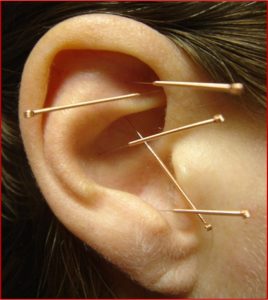Estudo confirma benefício da acupuntura auricular no tratamento da depressão